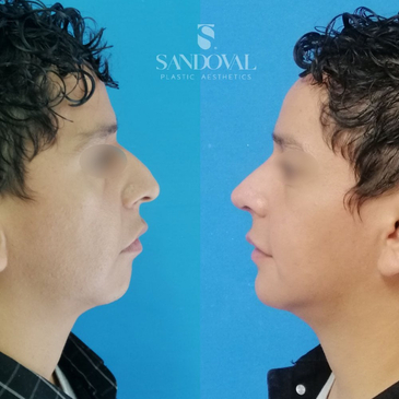Slider image (4) Dr. Gabriel Sandoval - Plastic Surgeon in Mexico